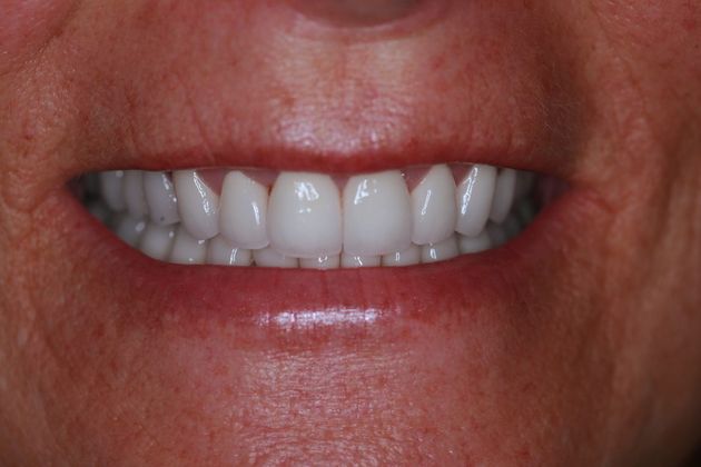 Full Mouth Rehabilitation: Mary - After