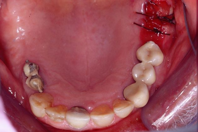 Full Mouth Rehabilitation: Bill - Before