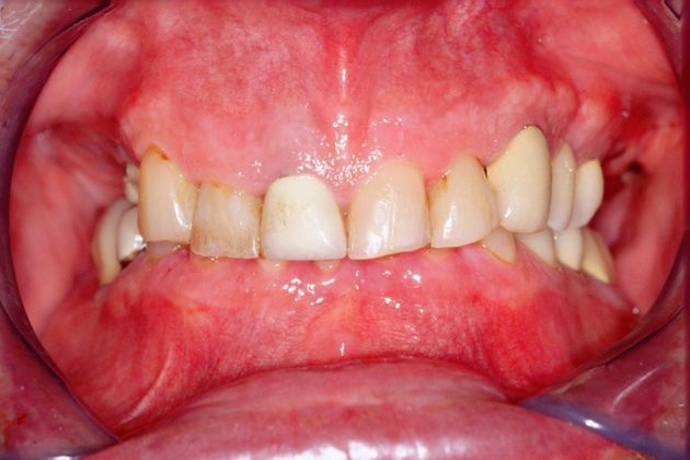 Full Mouth Rehabilitation: Bill - Before