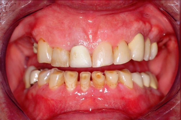 Full Mouth Rehabilitation: Bill - Before
