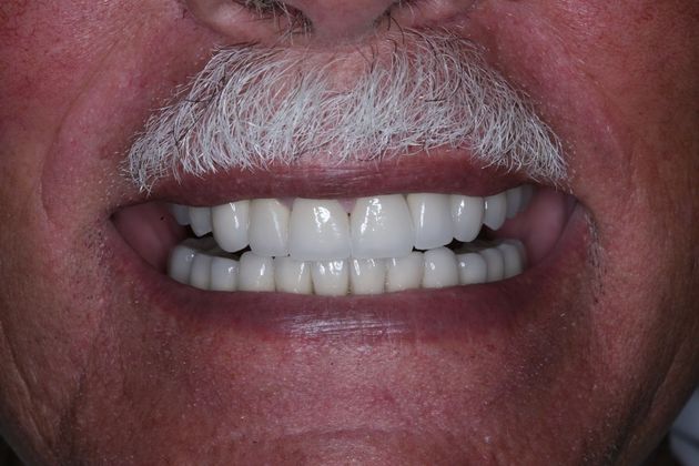 Full Mouth Rehabilitation: Bill - After