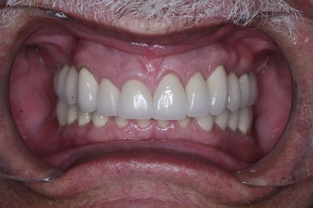 Full Mouth Rehabilitation: Bill - After