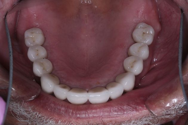 Full Mouth Rehabilitation: Bill - After