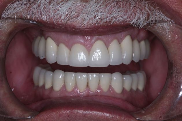 Full Mouth Rehabilitation: Bill - After