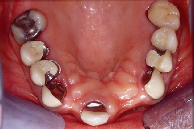 Full Mouth Rehabilitation: Tim - Before