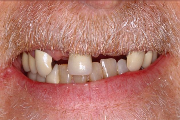 Full Mouth Rehabilitation: Tim - Before