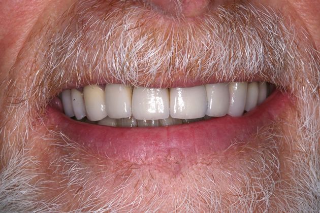 Full Mouth Rehabilitation: Tim - After