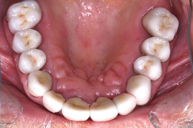 Full Mouth Rehabilitation: Tim - After