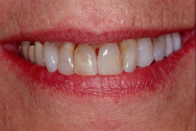 Full Mouth Rehabilitation: Carol - Before