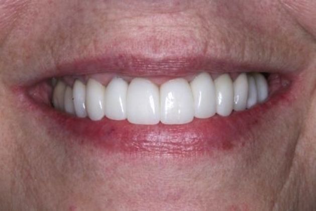 Full Mouth Rehabilitation: Carol - After