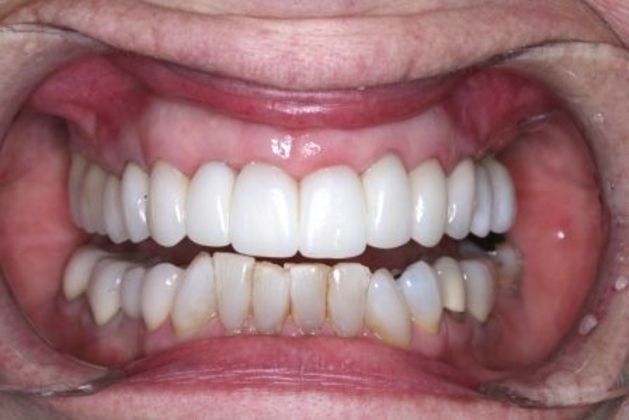 Full Mouth Rehabilitation: Carol