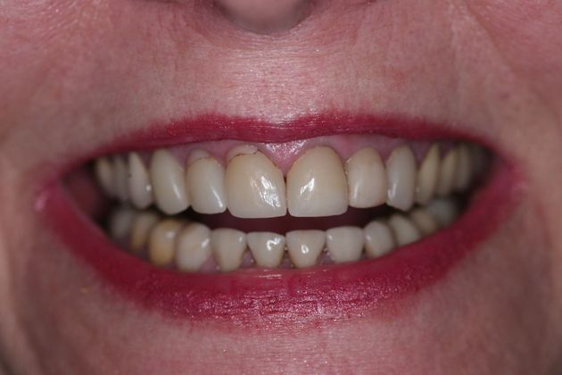 Full Mouth Rehabilitation Marilyn - Before