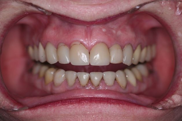 Full Mouth Rehabilitation: Marilyn - Before