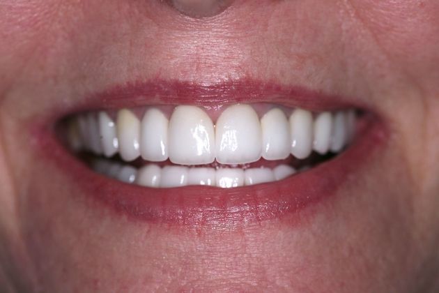 Full Mouth Rehabilitation Marilyn - After