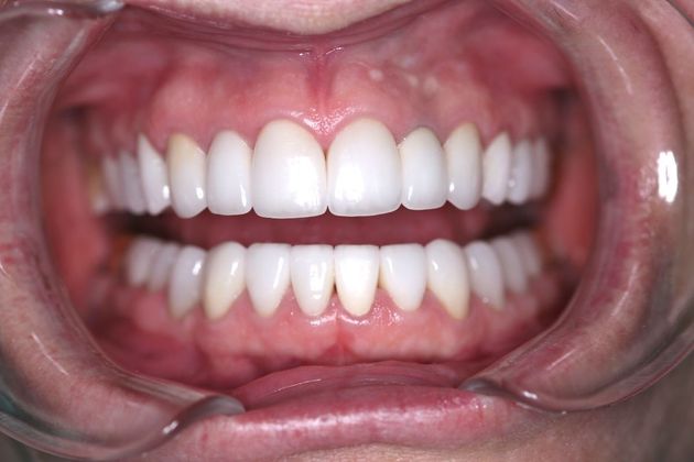 Full Mouth Rehabilitation: Marilyn - After