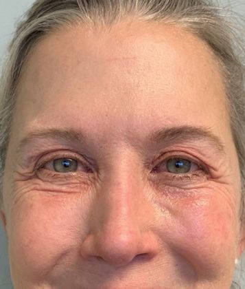Eyelid Lift: Case 13 - Eyelid Lift, Mini Browlift, New Canaan, CT - Before