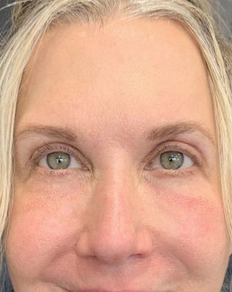 Eyelid Lift: Case 13 - Eyelid Lift, Mini Browlift, New Canaan, CT - After