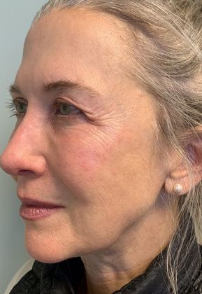 Facelift: Case 16 - Facelift, Eyelid lift, New Canaan, CT - Before