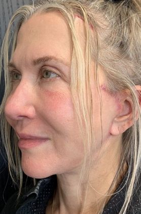 Facelift: Case 16 - Facelift, Eyelid lift, New Canaan, CT - After
