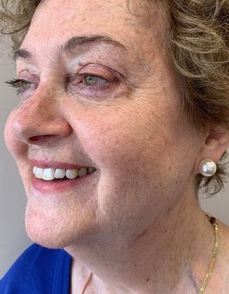 Facelift: Case 15 - Facelift, Necklift - Before