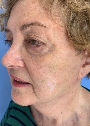 Facelift: Case 15 - Facelift, Necklift - After