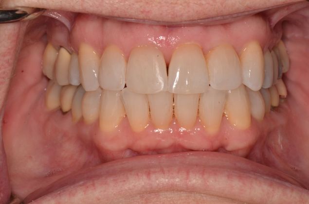 Invisalign Case 7 - After