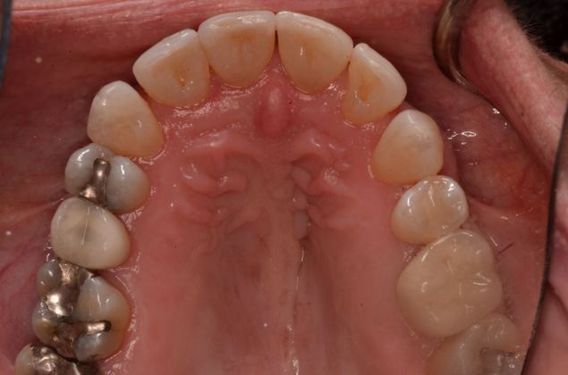 Invisalign: Case 7 - Before