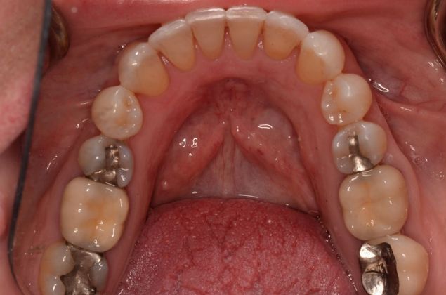 Invisalign: Case 7 - After