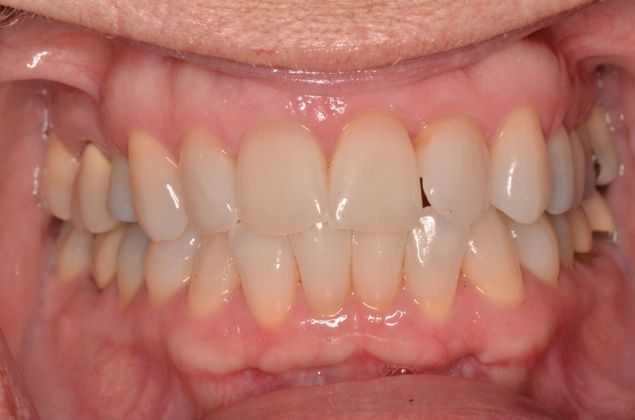 Invisalign Case 7 - Before