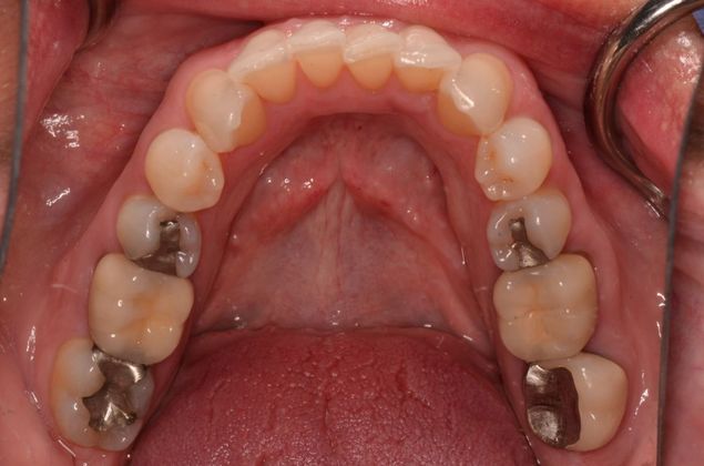 Invisalign: Case 7 - Before