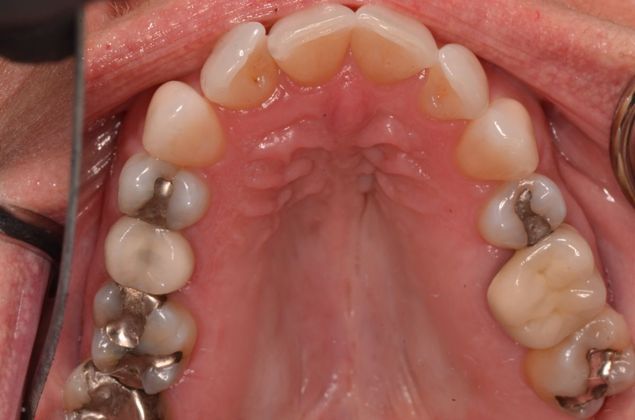 Invisalign: Case 7 - Before