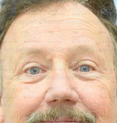 Blepharoplasty 65 year old patient with excess of skin in the upper eyelids - After