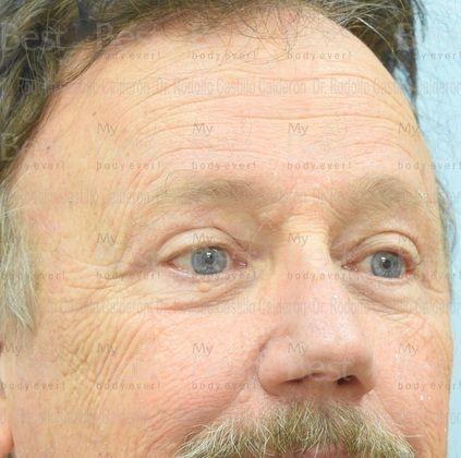 Blepharoplasty: 65 year old patient with excess of skin in the upper eyelids - After