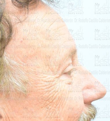 Blepharoplasty: 65 year old patient with excess of skin in the upper eyelids - After