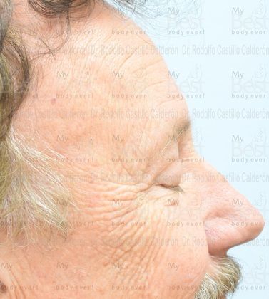 Blepharoplasty: 65 year old patient with excess of skin in the upper eyelids - After
