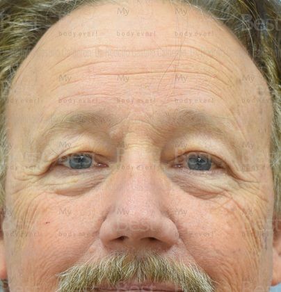 Blepharoplasty 65 year old patient with excess of skin in the upper eyelids - Before