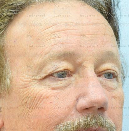 Blepharoplasty: 65 year old patient with excess of skin in the upper eyelids - Before
