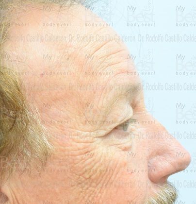 Blepharoplasty: 65 year old patient with excess of skin in the upper eyelids - Before