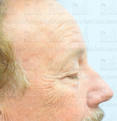 Blepharoplasty: 65 year old patient with excess of skin in the upper eyelids - Before