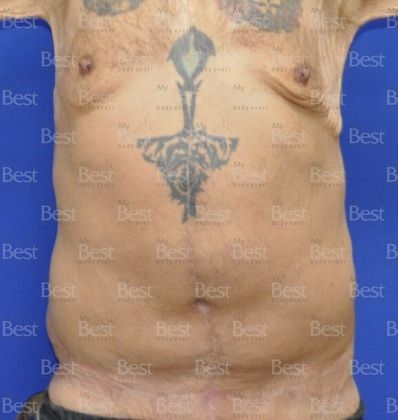 360 Tummy Tuck in Fleur de lis - Post Bariatric Plastic Surgery - Before  and After Gallery
