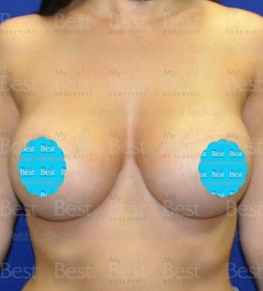 Breast Augmentation: Breast Augmentation with 470 gel filled breast implants - After