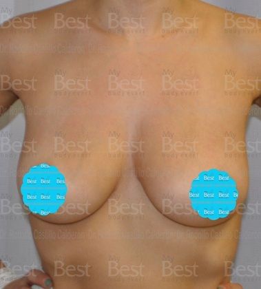 Breast Augmentation: Breast Augmentation with 470 gel filled breast implants - Before