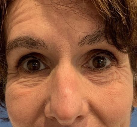 Eyelid Lift: Case 14 - Lower Eyelid Lift, Stamford, CT - Before