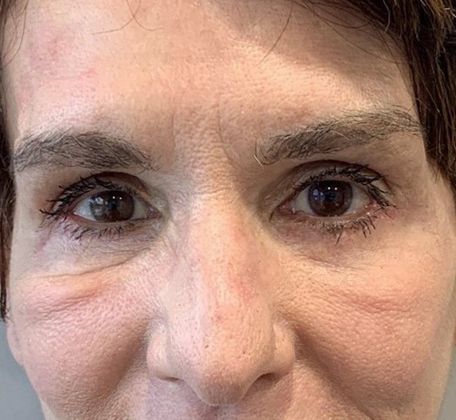 Eyelid Lift: Case 14 - Lower Eyelid Lift, Stamford, CT - After