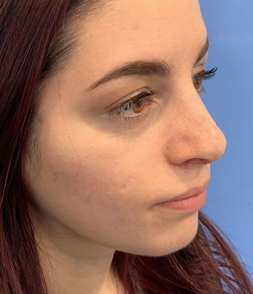 Rhinoplasty: Case 12 - Rhinoplasty, Septoplasty Seymour, CT - After