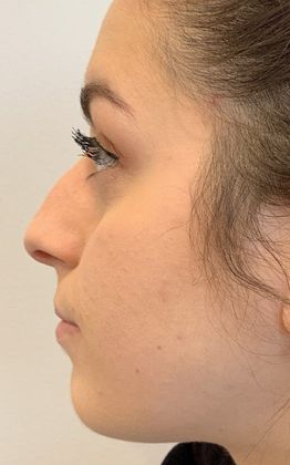 Rhinoplasty: Case 12 - Rhinoplasty, Septoplasty Seymour, CT - Before