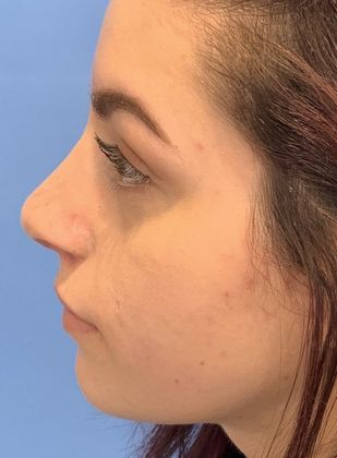 Rhinoplasty: Case 12 - Rhinoplasty, Septoplasty Seymour, CT - After