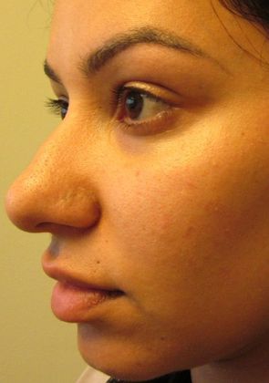 Rhinoplasty: Case 13 - Rhinoplasty, Septoplasty, Milford, CT - Before