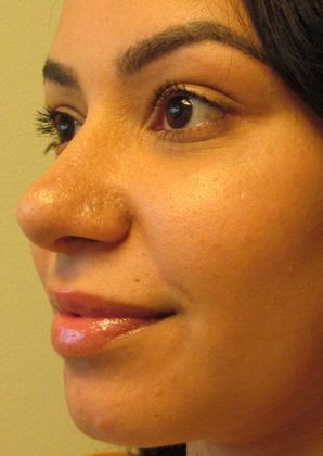 Rhinoplasty: Case 13 - Rhinoplasty, Septoplasty, Milford, CT - After