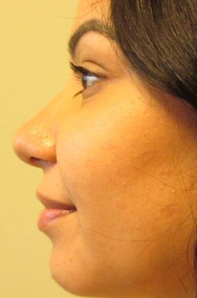 Rhinoplasty: Case 13 - Rhinoplasty, Septoplasty, Milford, CT - After